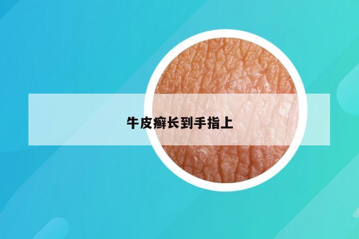牛皮癣长到手指上