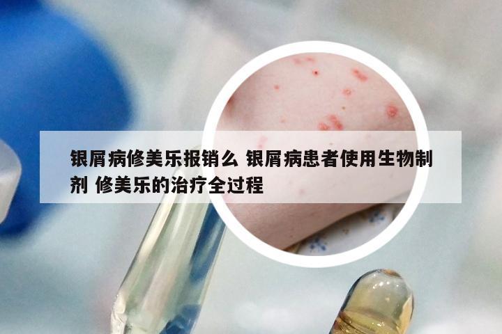 银屑病修美乐报销么 银屑病患者使用生物制剂 修美乐的治疗全过程