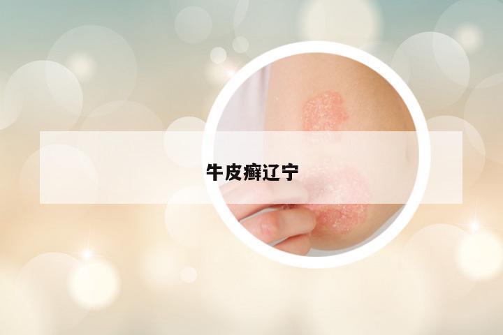 牛皮癣辽宁