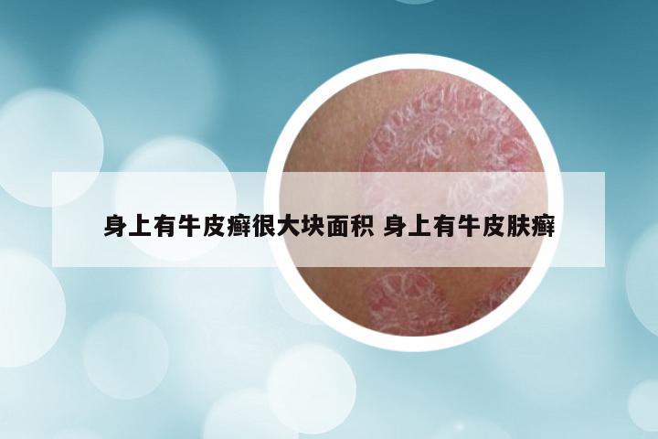 身上有牛皮癣很大块面积 身上有牛皮肤癣