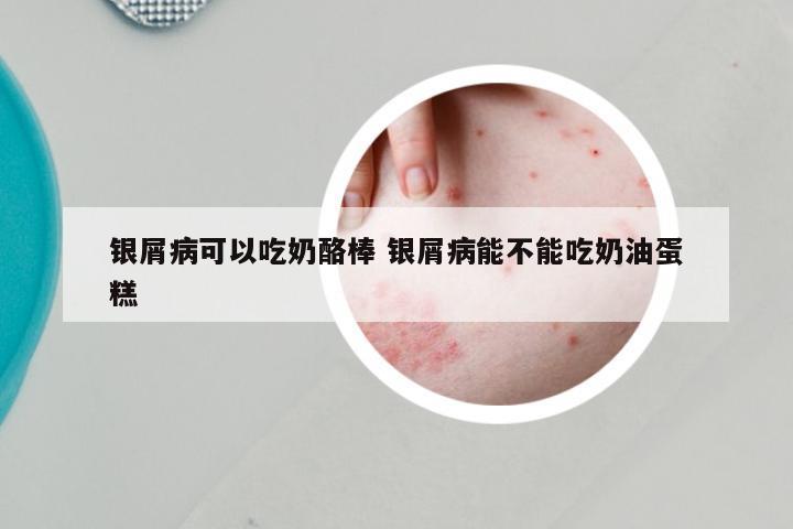 银屑病可以吃奶酪棒 银屑病能不能吃奶油蛋糕