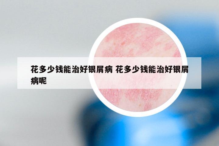 花多少钱能治好银屑病 花多少钱能治好银屑病呢