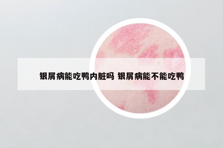 银屑病能吃鸭内脏吗 银屑病能不能吃鸭