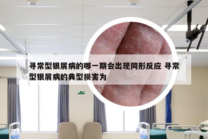 寻常型银屑病的哪一期会出现同形反应 寻常型银屑病的典型损害为