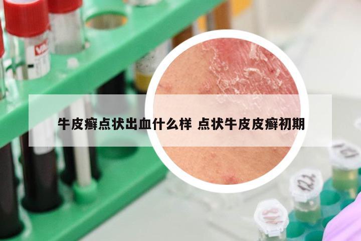牛皮癣点状出血什么样 点状牛皮皮癣初期