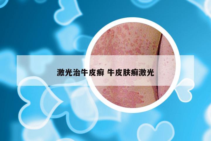 激光治牛皮癣 牛皮肤癣激光