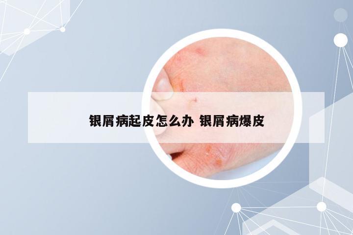 银屑病起皮怎么办 银屑病爆皮