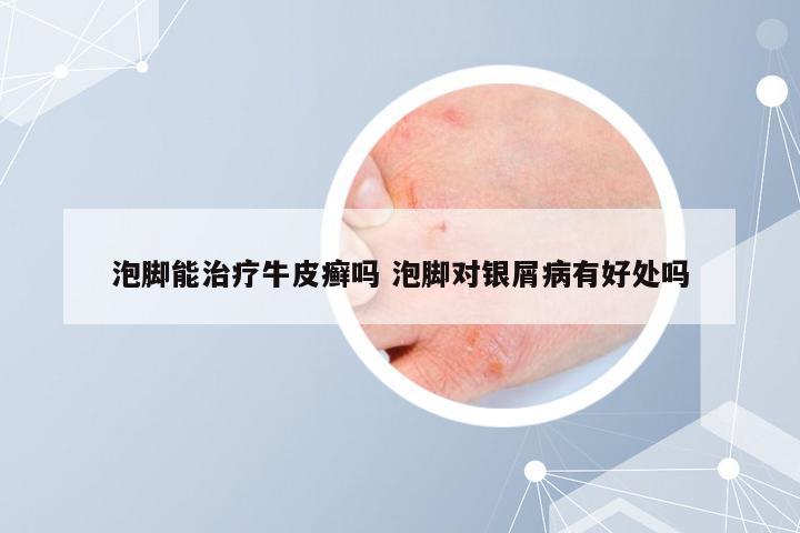 泡脚能治疗牛皮癣吗 泡脚对银屑病有好处吗