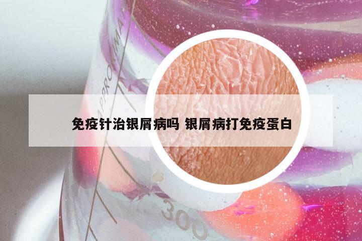免疫针治银屑病吗 银屑病打免疫蛋白