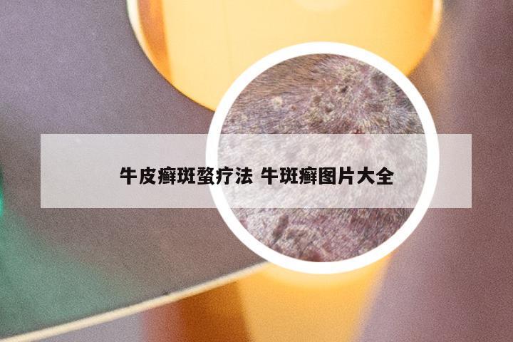 牛皮癣斑蝥疗法 牛斑癣图片大全