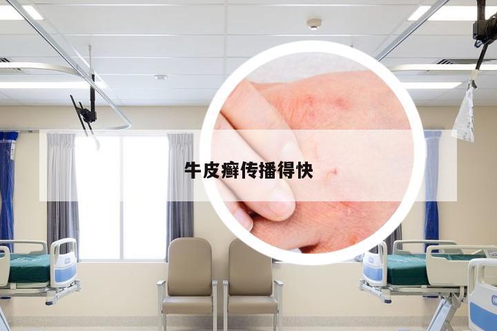 牛皮癣传播得快