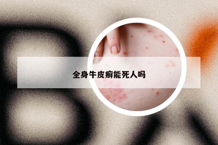 全身牛皮癣能死人吗