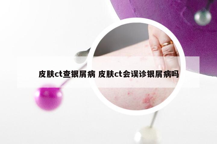 皮肤ct查银屑病 皮肤ct会误诊银屑病吗
