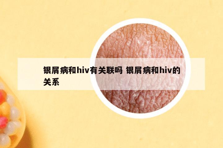 银屑病和hiv有关联吗 银屑病和hiv的关系