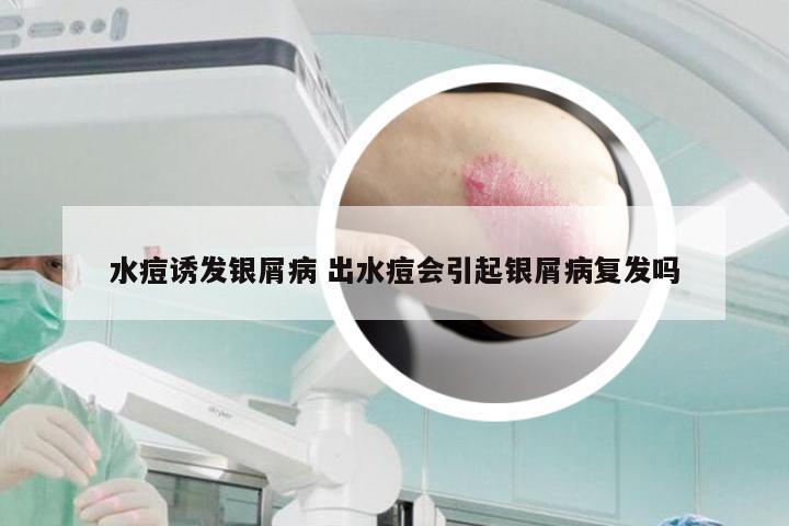水痘诱发银屑病 出水痘会引起银屑病复发吗