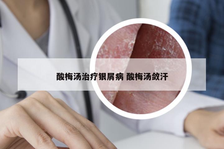 酸梅汤治疗银屑病 酸梅汤敛汗