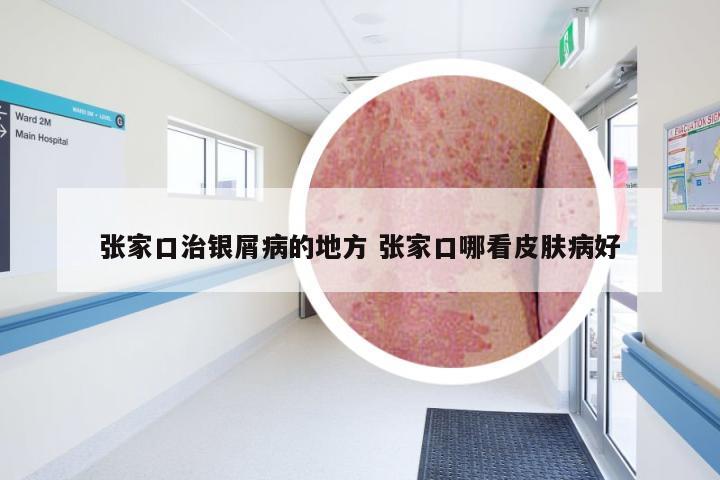 张家口治银屑病的地方 张家口哪看皮肤病好
