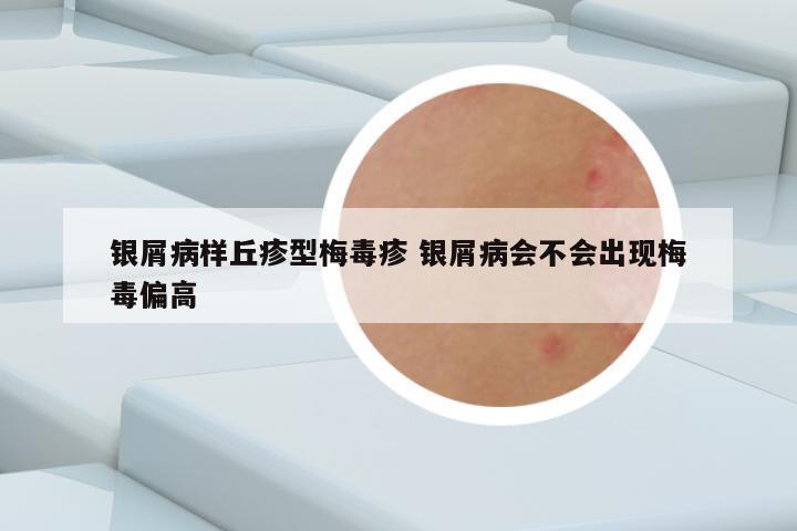 银屑病样丘疹型梅毒疹 银屑病会不会出现梅毒偏高
