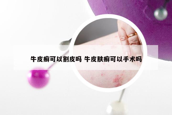 牛皮癣可以割皮吗 牛皮肤癣可以手术吗