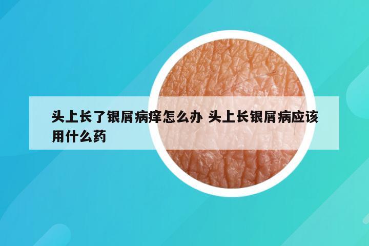 头上长了银屑病痒怎么办 头上长银屑病应该用什么药