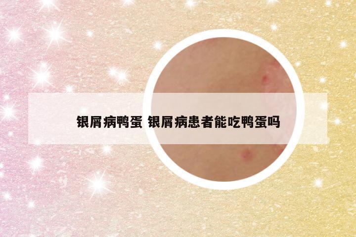 银屑病鸭蛋 银屑病患者能吃鸭蛋吗