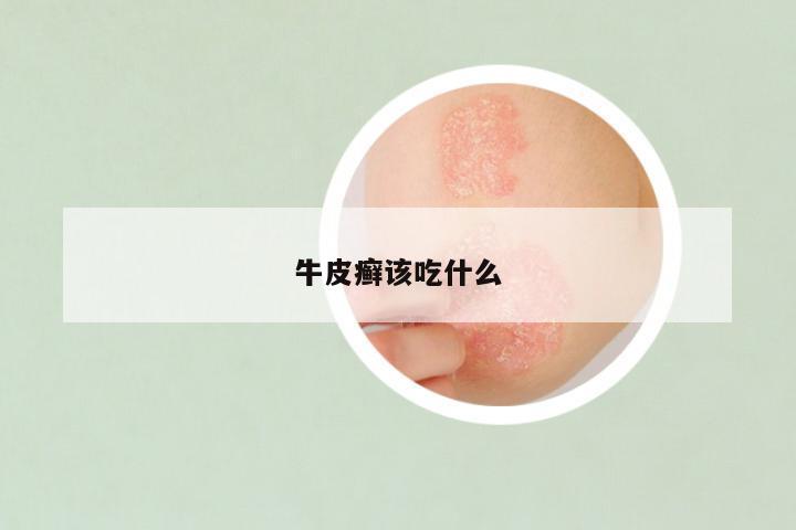 牛皮癣该吃什么