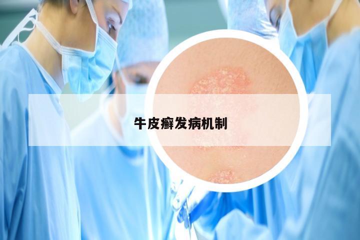 牛皮癣发病机制