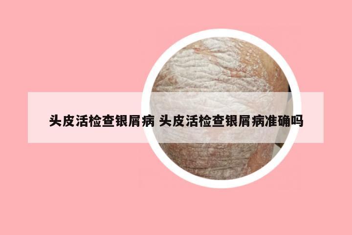 头皮活检查银屑病 头皮活检查银屑病准确吗