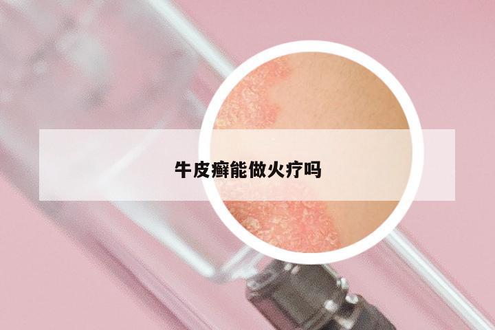 牛皮癣能做火疗吗