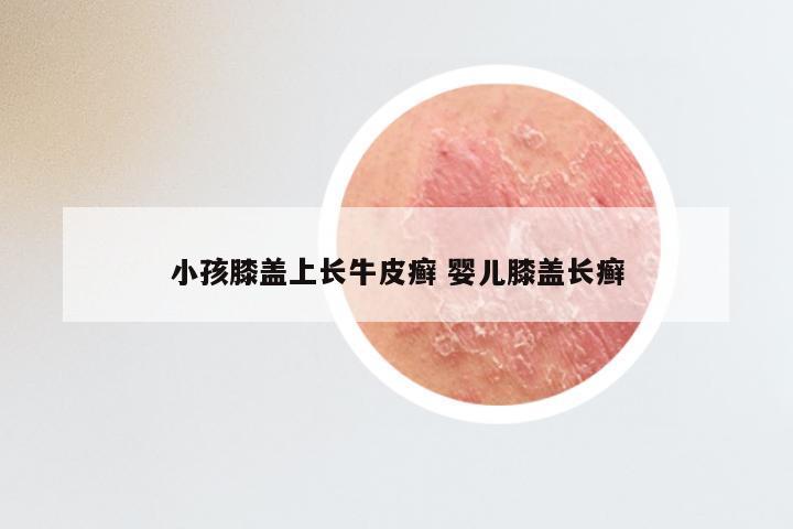 小孩膝盖上长牛皮癣 婴儿膝盖长癣
