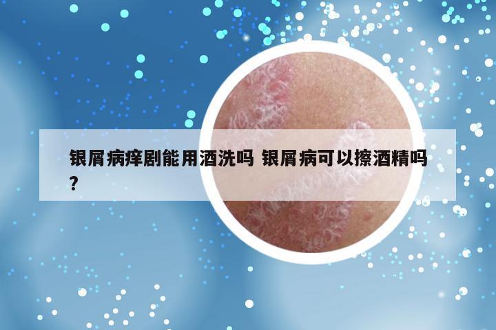 银屑病痒剧能用酒洗吗 银屑病可以擦酒精吗?