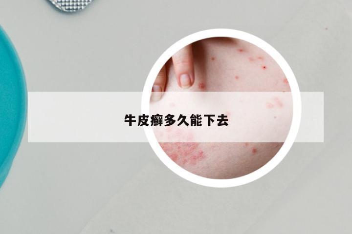牛皮癣多久能下去