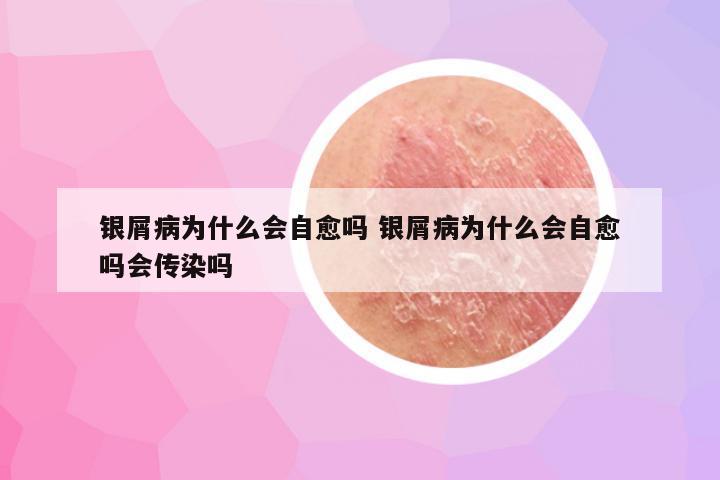 银屑病为什么会自愈吗 银屑病为什么会自愈吗会传染吗