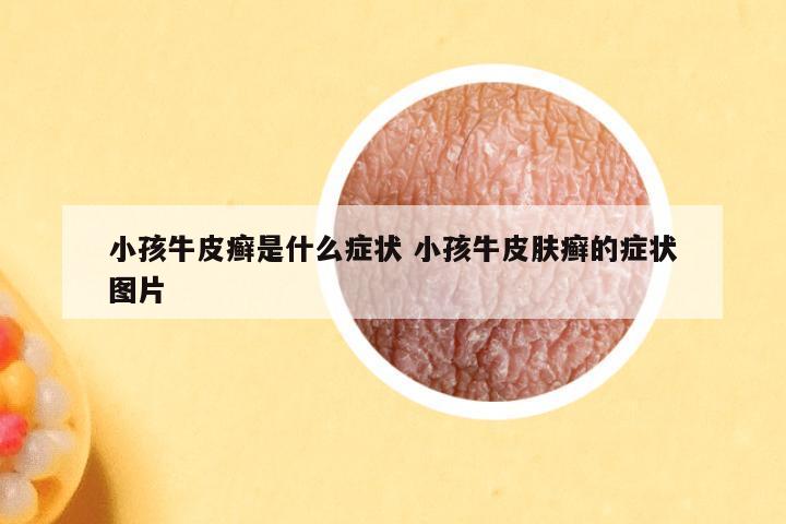 小孩牛皮癣是什么症状 小孩牛皮肤癣的症状图片
