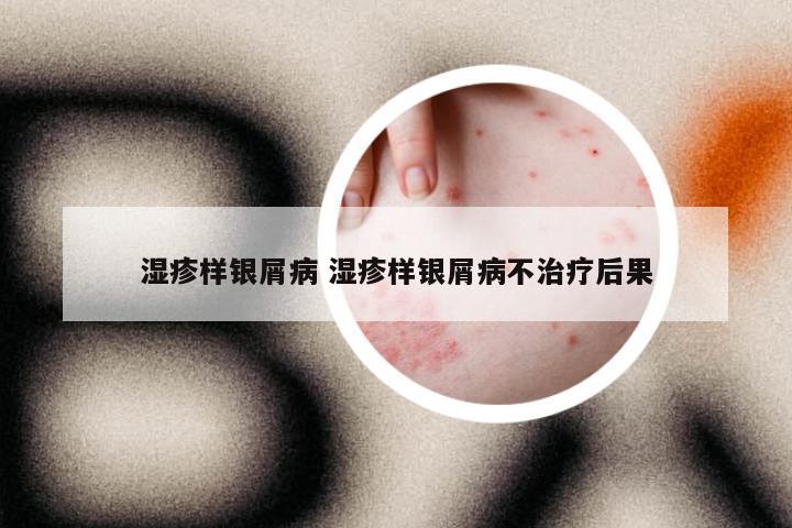 湿疹样银屑病 湿疹样银屑病不治疗后果