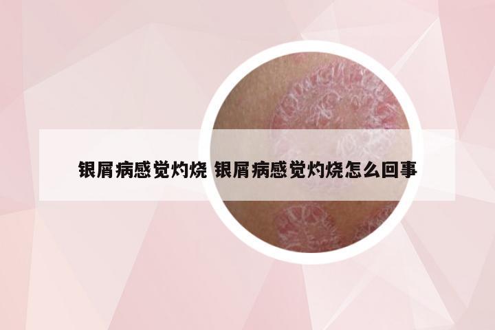 银屑病感觉灼烧 银屑病感觉灼烧怎么回事