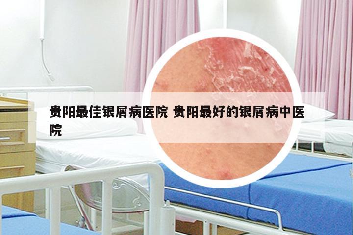 贵阳最佳银屑病医院 贵阳最好的银屑病中医院