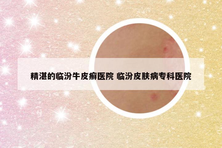 精湛的临汾牛皮癣医院 临汾皮肤病专科医院