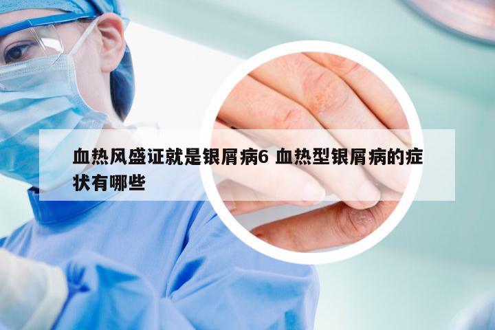 血热风盛证就是银屑病6 血热型银屑病的症状有哪些