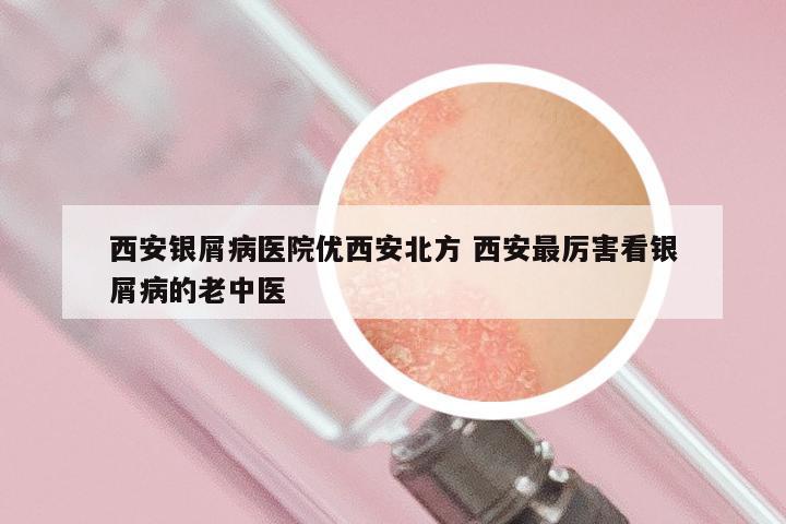 西安银屑病医院优西安北方 西安最厉害看银屑病的老中医