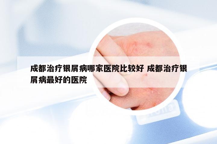 成都治疗银屑病哪家医院比较好 成都治疗银屑病最好的医院