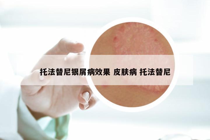 托法替尼银屑病效果 皮肤病 托法替尼