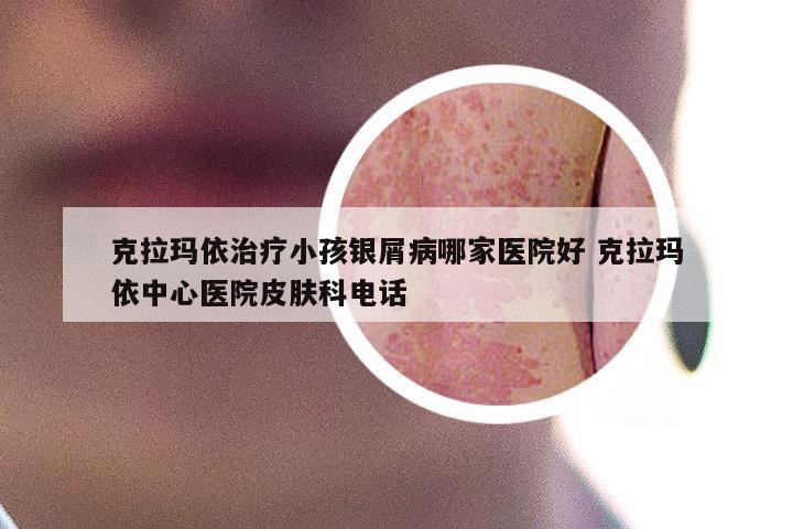 克拉玛依治疗小孩银屑病哪家医院好 克拉玛依中心医院皮肤科电话