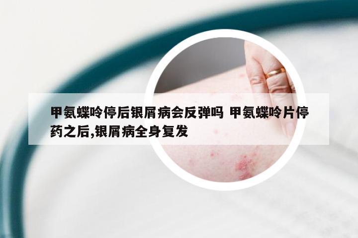 甲氨蝶呤停后银屑病会反弹吗 甲氨蝶呤片停药之后,银屑病全身复发