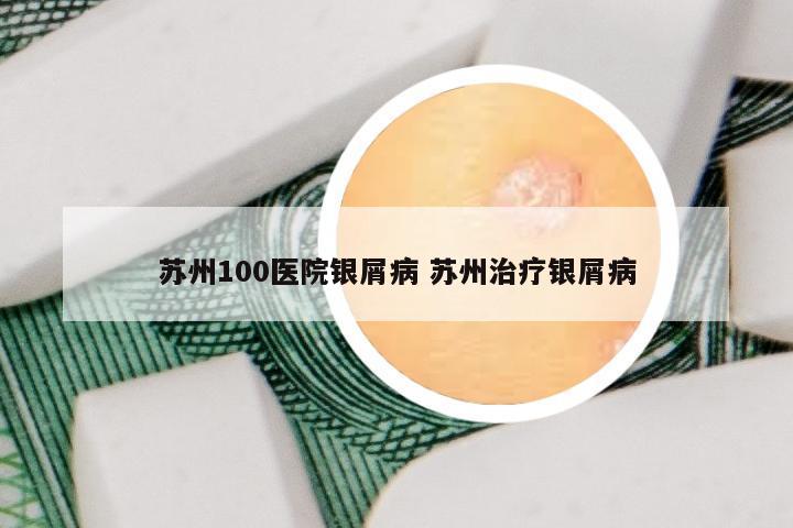 苏州100医院银屑病 苏州治疗银屑病