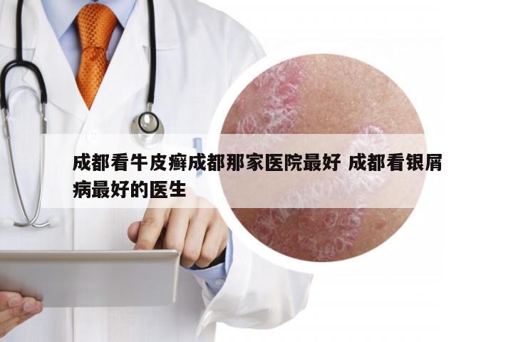 成都看牛皮癣成都那家医院最好 成都看银屑病最好的医生