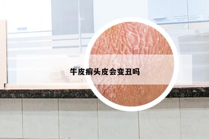 牛皮癣头皮会变丑吗