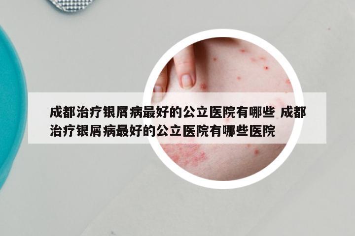 成都治疗银屑病最好的公立医院有哪些 成都治疗银屑病最好的公立医院有哪些医院