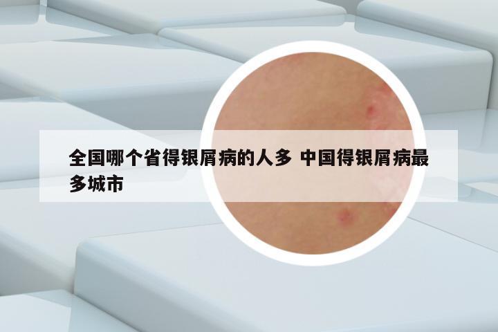 全国哪个省得银屑病的人多 中国得银屑病最多城市