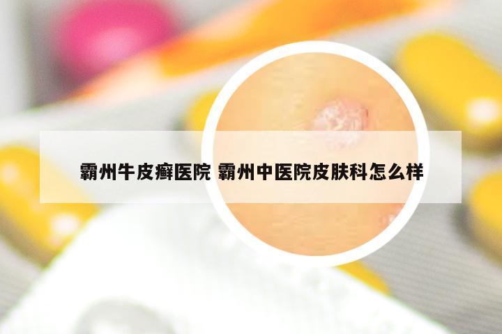 霸州牛皮癣医院 霸州中医院皮肤科怎么样